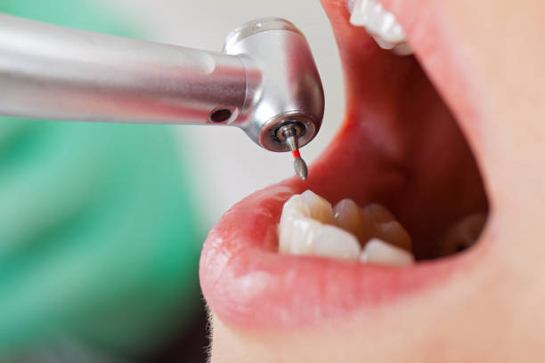 Best Emergency Dentist for Knocked-Out Tooth in Erlanger, KY